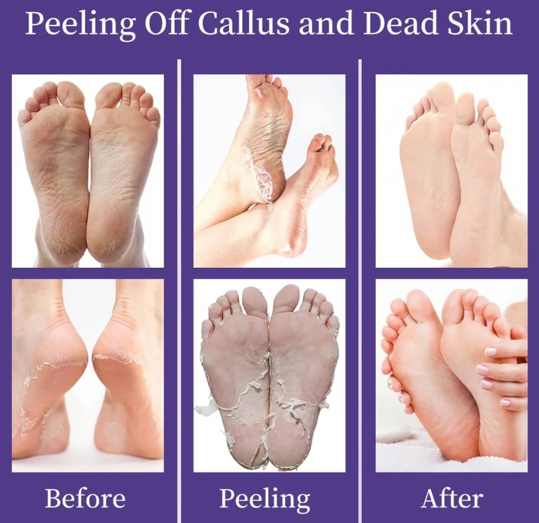 Masque exfoliant pieds - chaussettes peeling